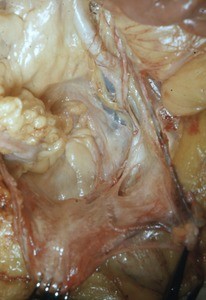 Natural color photograph of dissection of the pelvic cavity, anterior view, with the uterus retracted anteriorly to expose the rectouterine pouch (pouch of Douglas) and vessels associated with the lateral wall of the pelvic cavity