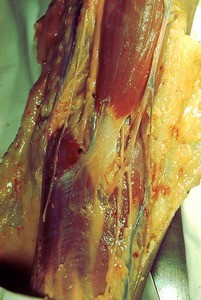 Natural color photograph of dissection of the left cubital fossa, anterior view