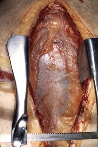 Natural color photograph of dissection of the thorax, anterior view, with the skin and divided sternum retracted to expose the parietal pleura overlying the cardiac region