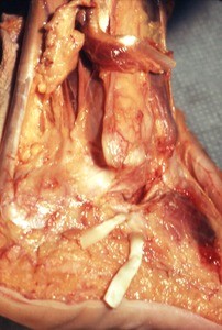 Natural color photograph of dissection of the right ankle, lateral view, showing tendons and musculature