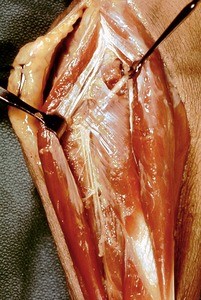 Natural color photograph of dissection of the forearm