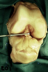 Natural color photograph of dissection of the right knee, anterior view, with the patella reflected inferiorly and the forceps holding the anterior cruciate ligament