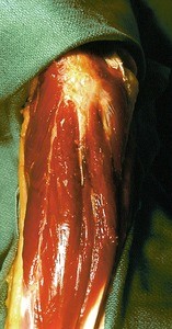 Natural color photograph of dissection of the elbow, showing associated musculature