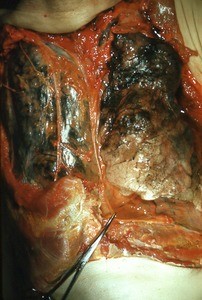 Natural color photograph of dissection of the thorax, anterior view, with the rib cage removed to expose the lungs and phrenic nerves