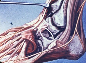 Illustration of left ankle and foot, dorsolateral aspect, dissected to show lateral malleolus, tarsal bones and (emphasized) the tarsal sinus highlighted with a white oval