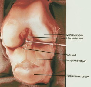 Natural color photograph of right knee, anterior view, showing bones and ligaments with the patellar reflected and the knee joint opened