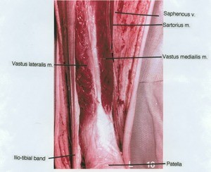 Natural color photograph of dissection of the right anterior thigh, showing the significant musculature