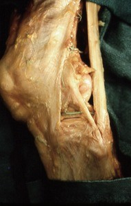 Natural color photograph of dissection of the left knee, lateral view