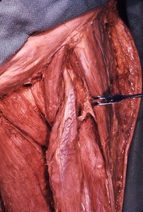 Natural color photograph of dissection of the left thigh, anterior view, with the femoral artery and vein cut and removed