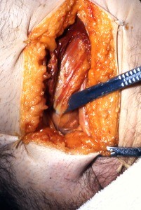 Natural color photograph of dissection of the left inguinal region, anterior view