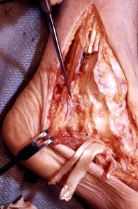 Natural color photograph of dissection of the left ankle, medial view, exposing the posterior tibial artery and nerve, with the tibialis posterior t. and the flexor digitorum longus t. cut and reflected