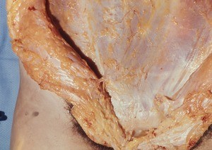 Natural color photograph of the abdominal wall, anterior view, showing superficial vessels and nerves