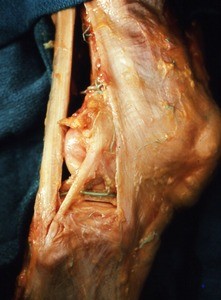 Natural color photograph of dissection of the right knee, lateral view, emphasizing the fibular collateral ligament and the biceps femoris tendon