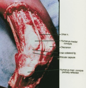 Natural color photograph of right elbow, medial view, showing bones, ligament and ulna nerve with the medial condyle of humerus partially reflected
