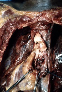 Natural color photograph of dissection of the heart, anteriosuperior view, showing trauma to the great vessels