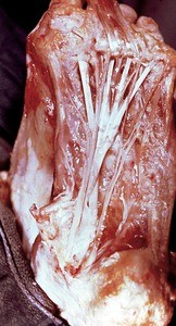 Natural color photograph of dissection of the plantar surface of the left foot