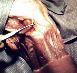 Natural color photograph of dissection of the right knee, lateral view, with the foreceps holding the fibular collateral ligament