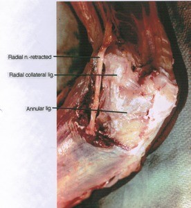 Natural color photograph of right elbow, anterior view, showing ligments and nerve
