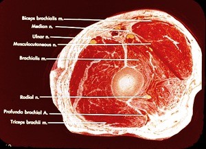 Color photograph of cross section of right arm, showing arteries, bone, nerves and muscles