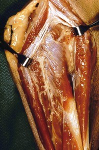 Natural color photograph of dissection of the forearm