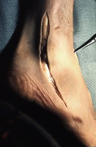 Natural color photograph of dissection of the right ankle, lateral view, showing initial incision