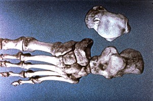 Illustration of bones of left foot, dorsal view