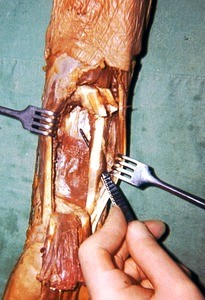 Natural color photograph of dissection of the left forearm, anterior view, emphasizing the flexor carpi radialis muscle