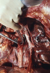 Natural color photograph of dissection of the thorax, anterior view, with the rib cage and heart removed and brachiocephalic trunk reflected to reveal a penetrating wound in the esophagus