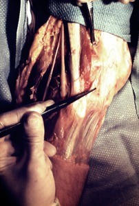 Natural color photograph of dissection of the right knee, lateral view, with the foreceps holding the fibular collateral ligament