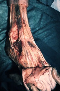 Natural color photograph of dissection of the right foot, anterolateral view, exposing the structures of the dorsal surface