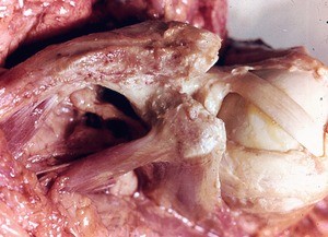 Natural color photograph of dissection of the left shoulder, anterior view, showing the attachment of the tendons of the short head of the biceps brachii muscle, coracobrachialis muscle, and pectoralis minor muscle to the coracoid process