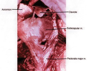 Natural color photograph of dissection of the right shoulder, lateral view, showing major bone structure and muscles
