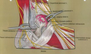 Illustration of dissection of the left ankle, medial view, showing the ankle joint and related structures, with the inferior extensor retinaculum cut and reflected