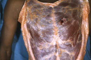 Natural color photograph of dissection of the thorax, anterior view, showing the superficial musculature with a penetrating wound in the upper left quadrant