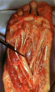 Natural color photograph of dissection of the plantar surface of the right foot