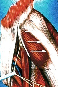 Illustration of left inguinal & anterior thigh region, showing iliotibial tract (arrows); dashed line indicates incision-line for exposure of proximal part of lateral femoral cutaneous nerve