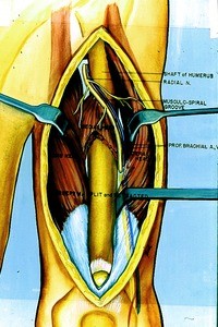 Illustration of dissected anterior surface of humerus and muscles, arteries veins & nn. of left arm