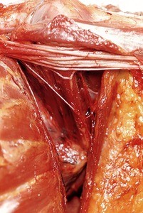 Natural color photograph of dissection of the left axilla, anterior view, showing the brachial plexus