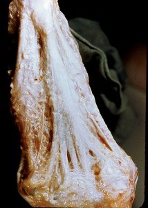 Natural color photograph of dissection of the plantar surface of the left foot