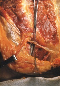 Natural color photograph of the right spermatic cord, anterior view, with the vas deferens removed