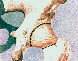 Illustration of posterior view of dissected right hip, showing iliofemoral ligament