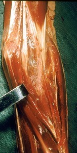 Natural color photograph of dissection of the left cubital fossa, anteromedial view