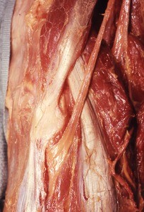 Natural color photograph of dissection of the left popliteal fossa, emphasizing the common fibular nerve as it courses inferior to the fibular head