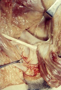 Natural color photograph of dissection of the right inguinal region, anterior view, showing the spermatic cord and the inguinal ligament