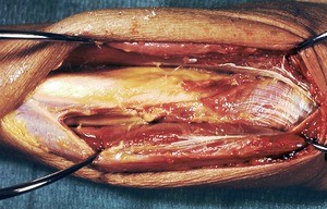 Natural color photograph of dissection of the forearm