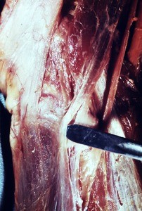 Natural color photograph of dissection of the left knee, lateral view, with the scalpel in the biceps femoris tendon