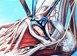 Illustration of dissection of left ankle and foot, anterolateral view, inferior extensor retinaculum split and retracted