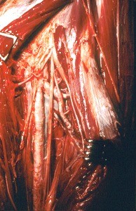 Natural color photograph of dissection of the thigh, anterior view, showing major muscles and vessels