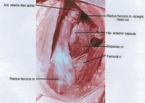 Natural color photograph of dissection of the musculature overlying the right hip joint, anterior view, with the rectus femoris muscle cut