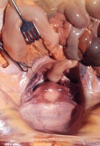 Natural color photograph of dissection of the pelvic cavity, superior view, with the abdominal viscera retracted to show the rectum, uterus, and bladder